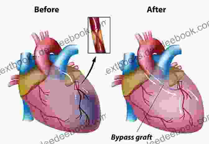 A Surgeon Performing An Off Pump Coronary Artery Bypass Surgery On A Patient. The Surgeon Is Using A Heart Stabilizer To Keep The Heart In A Fixed Position While Attaching A Bypass Graft To A Coronary Artery. Off Pump Coronary Artery Bypass