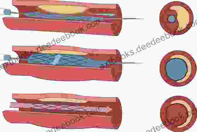 Lasers Used In Cardiovascular Interventions, Including Angioplasty, Atherectomy, And Stent Placement. Lasers In Cardiovascular Interventions