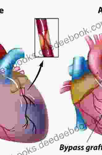 Off Pump Coronary Artery Bypass